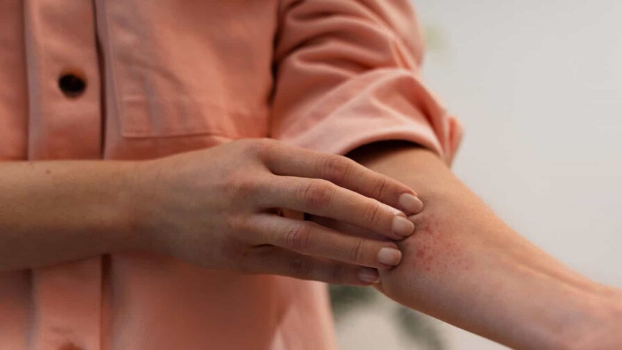 Prevén lluvias, tormentas eléctricas y ráfagas en el clima en RD Dermatitis por calor: cómo reconocerla y prevenirla